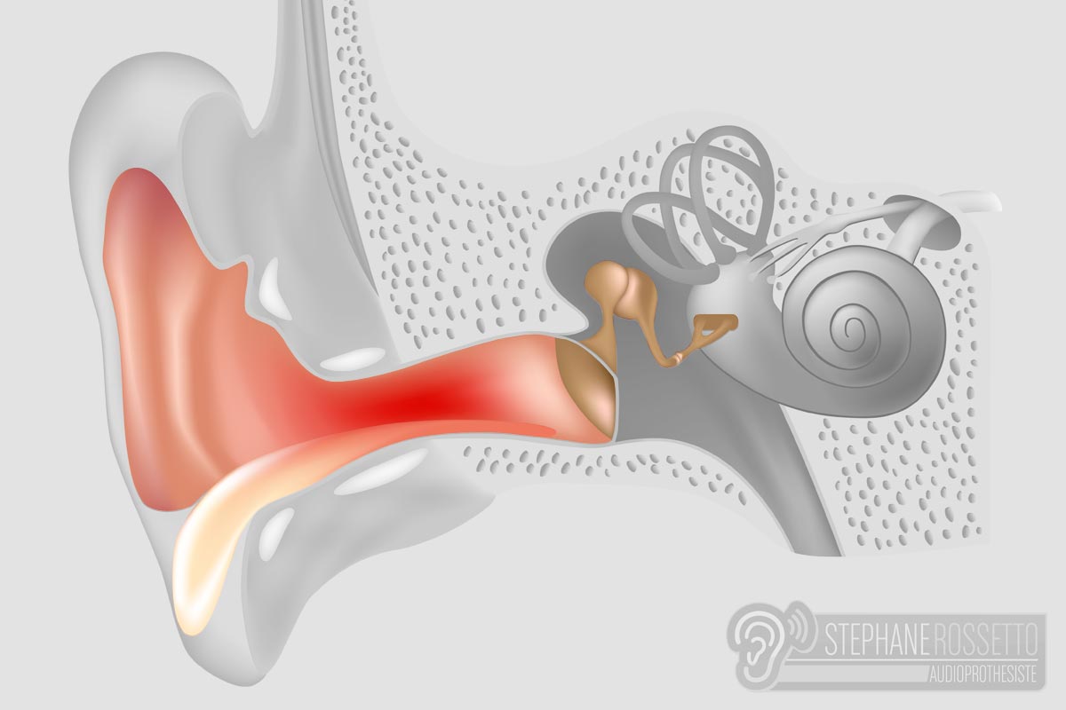 Внутреннее ухо лечение и симптомы. Тимпаногенный лабиринтит. Лабиринтит мезотимпанит. Катаральный наружный отит. Острый катаральный отит уха.