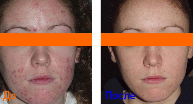фото до и после PRP-терапии кожи лица