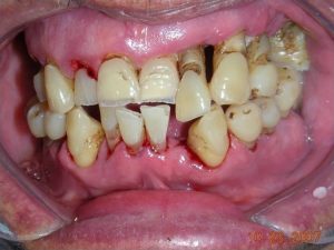 periodontitis