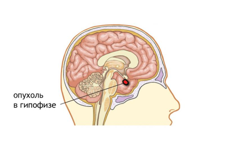 Аденома гипофиза головного мозга. Опухоль микроаденома гипофиза. Гипоталамус гипофиз эпифиз. Гипофиз головного мозга доброкачественная опухоль. Опухоль гипофиза доброкачественная операция.