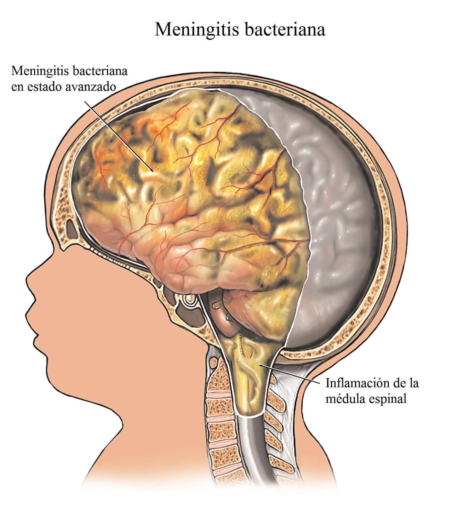 Менингит у ребенка 3. Цереброспинальный Гнойный менингит. Оболочка головного мозга менингит. Серозный менингит макропрепарат. Цереброспинальный туберкулезный менингит.