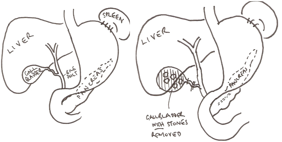 laparoscopicCholecystectomy1