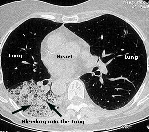 Lungs