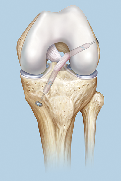 Передние крестообразные связки колена фото