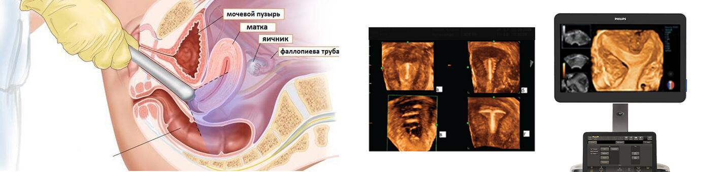 Узи органов таза. УЗИ ОМТ трансвагинально. УЗИ малый таз трансвагинально. УЗИ ОМТ абдоминальным датчиком. Ультразвуковое исследование матки и придатков трансвагинальное.