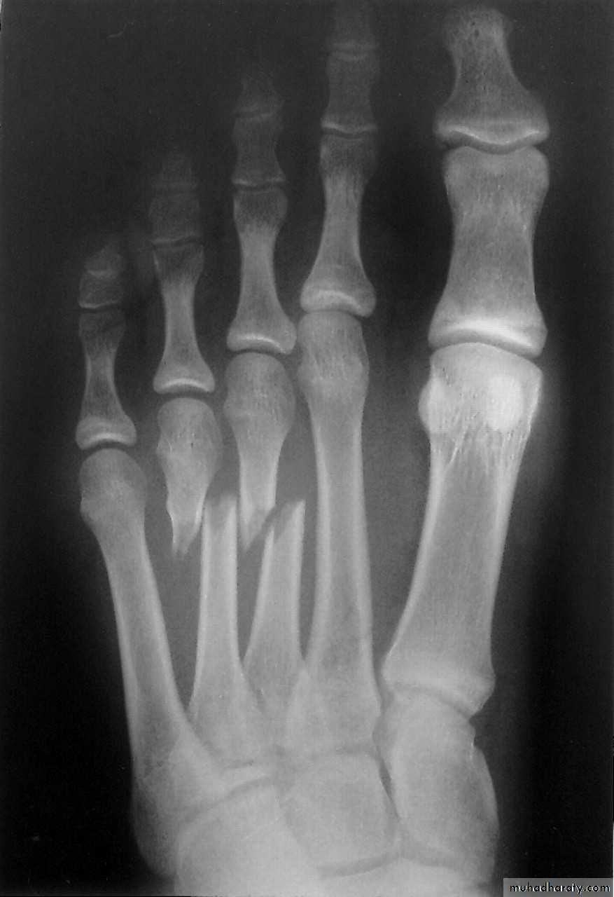 Перелом 3 плюсневой кости руки
