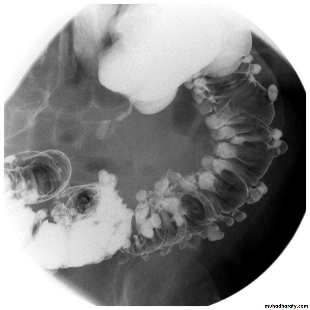 Дивертикулез толстой кишки рентген