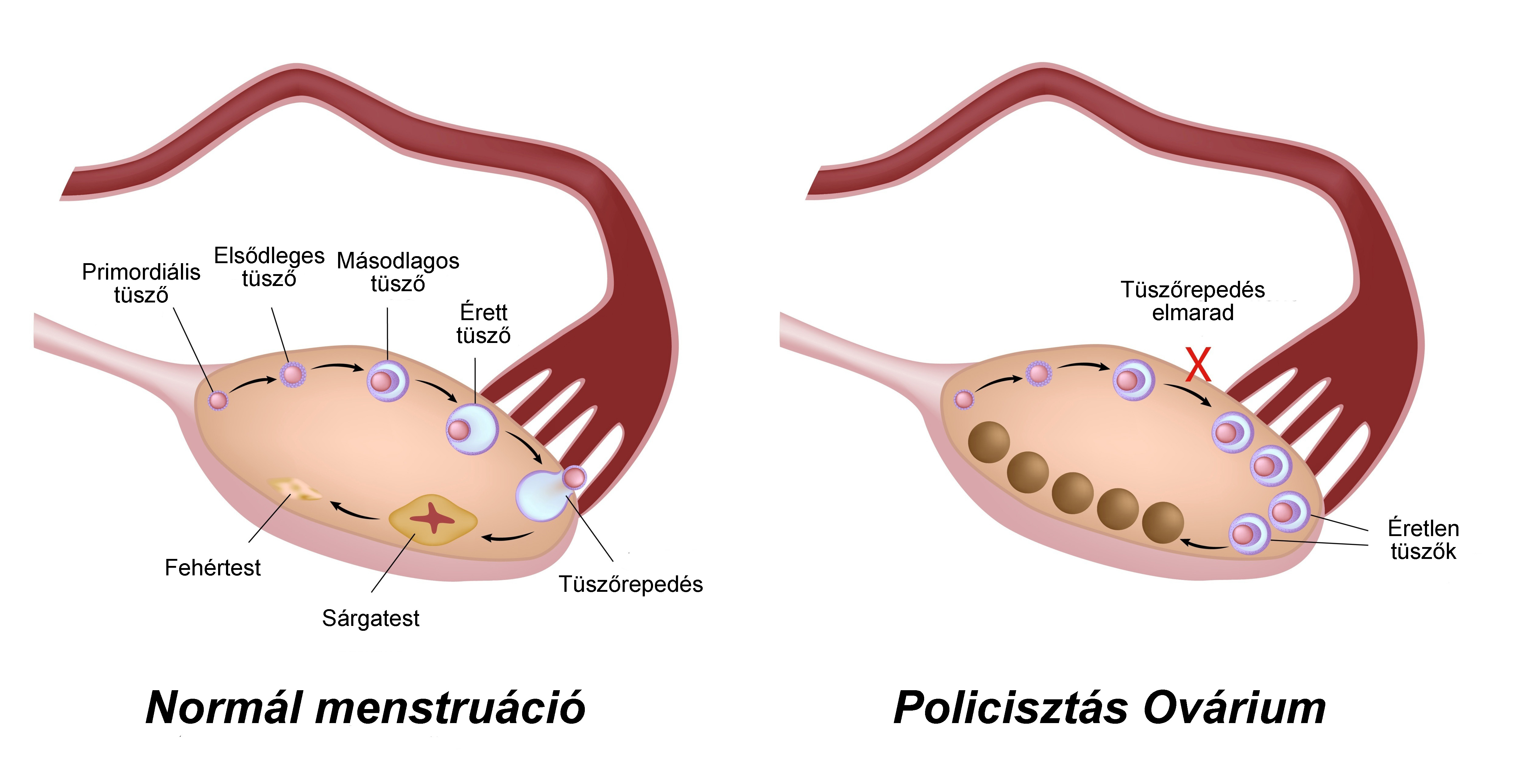 Ovario poliquistico y fertilidad