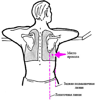 Торакоцентез