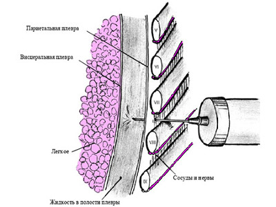 Техника проведения плевральной пункции