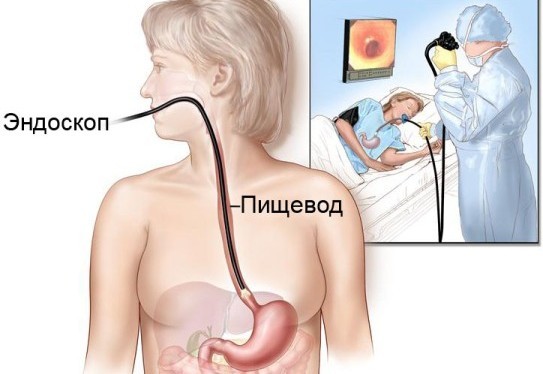 Эзофагоскопия при ахалазии кардии пищевода