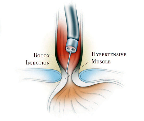 инъекции ботулотоксина в лечении ахалазии кардии пищевода