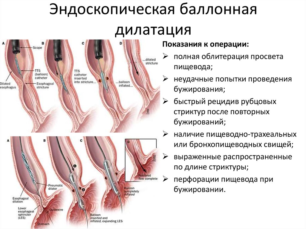 Пневмокардиодилатация при ахалазии пищевода