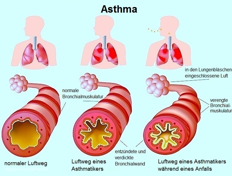 Bronchial asthma. Патогенез бронхиальной астмы. Патогенез аллергической бронхиальной астмы. Патогенез атопической астмы. Критерии атопической бронхиальной астмы.