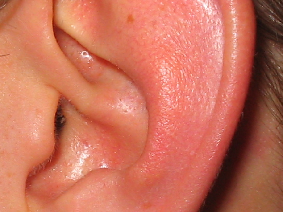 Грибковое заболевание уха