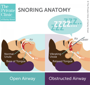 laser treatment for snoring london UK