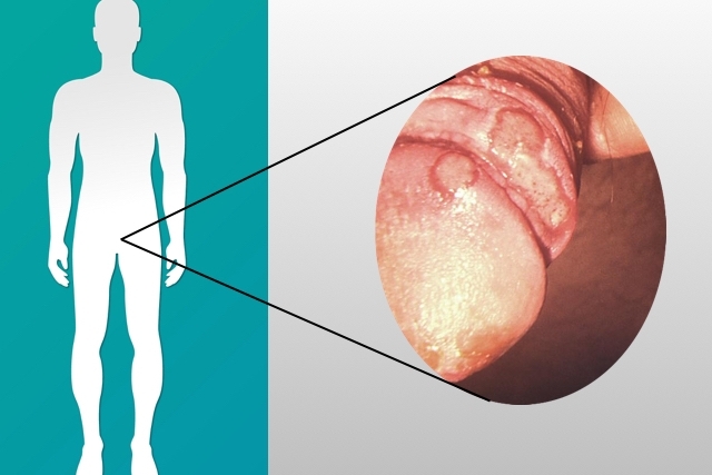 Photo of candidiasis in men