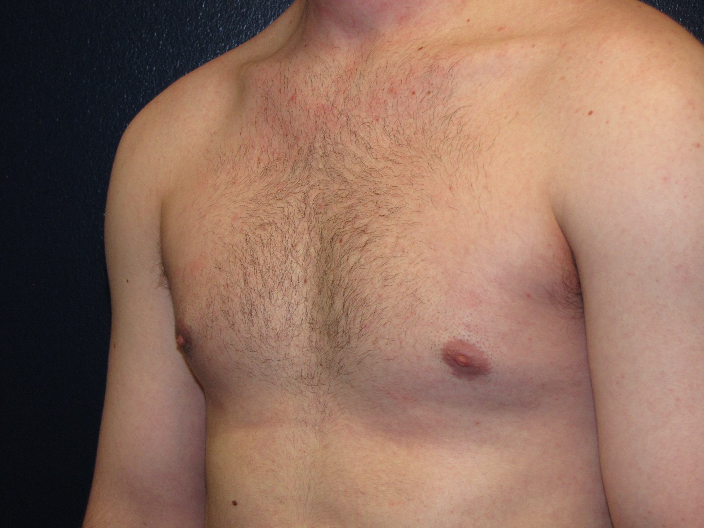 воронкообразная грудь у мужчин фото 66