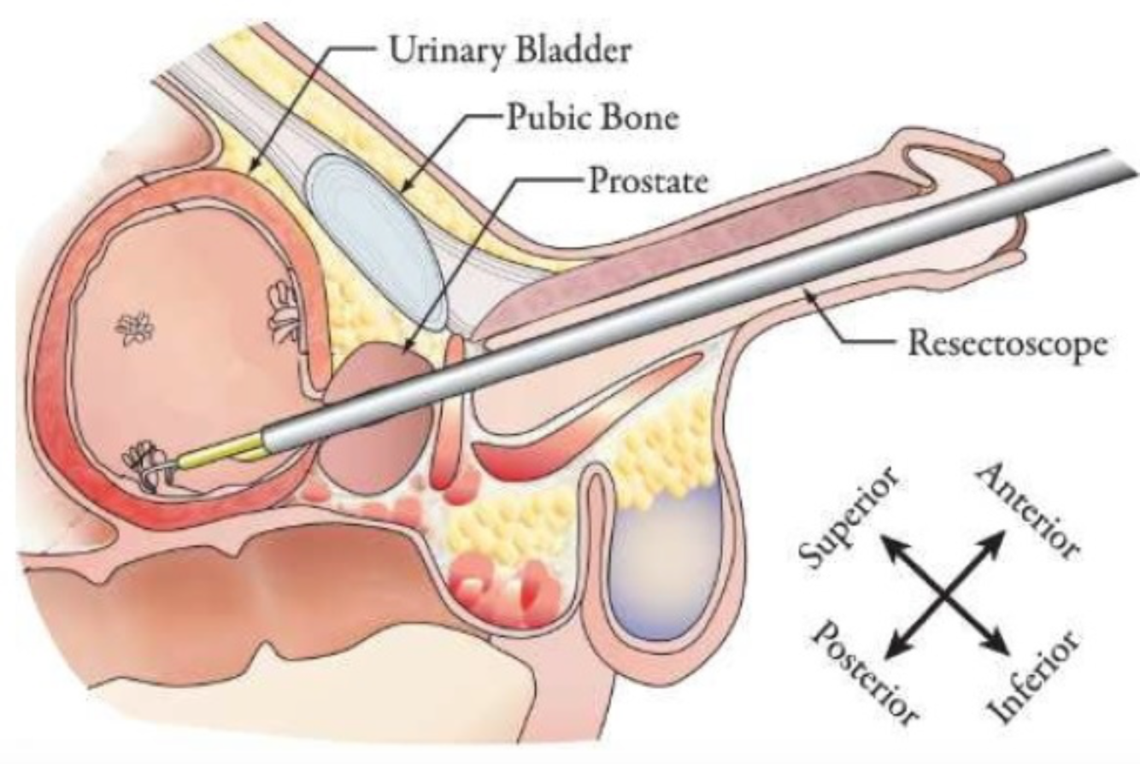 Удаление предстательной. Трансуретральная резекция. Тур трансуретральная резекция простаты. Трансуретральная резекция стенки мочевого пузыря. Трансуретральная резекция (тур) мочевого пузыря это.