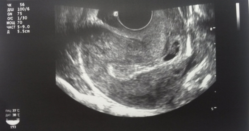 Беременность 6 7 недель выделения. Шеечная беременность УЗИ. Плод на 7 неделе беременности УЗИ. 7 Недель беременности фото плода на УЗИ. Беременность 6-7 недель фото эмбриона.