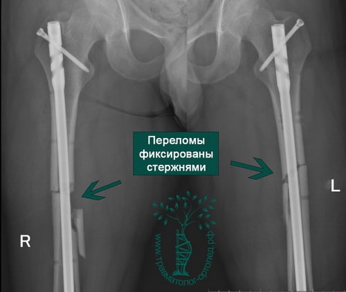 Перелом бедра операция. Перелом бедренной кости пластиной.