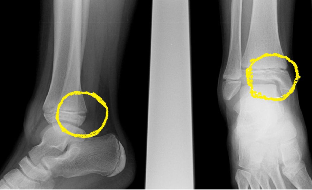 Костная мозоль у детей. Перелом наружной лодыжки рентген. Эпифизеолиз лодыжки Салтер Харрис. Перелом голеностопа эпифизеолиз.
