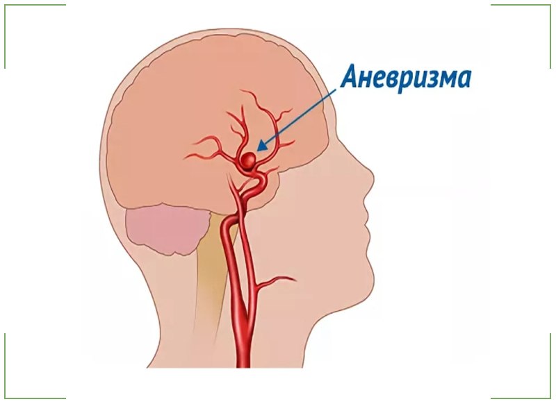 Аневризма сосудов головного мозга презентация