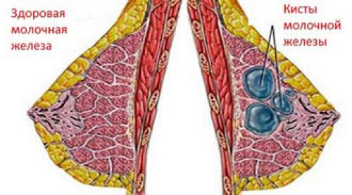 Киста молочной железы, что это такое, как лечить. Симптомы и методы лечения кисты молочных желез