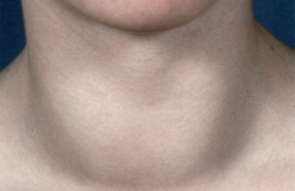 Припухлость бока. Увеличенаящитовидная железа. Увеличенная щитовидная железа.